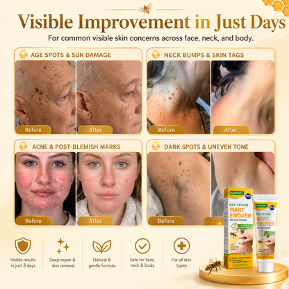 Fade Warts, Smooth Texture, Even Tone — One Cream For Complete Wart Removal & Skin Recovery