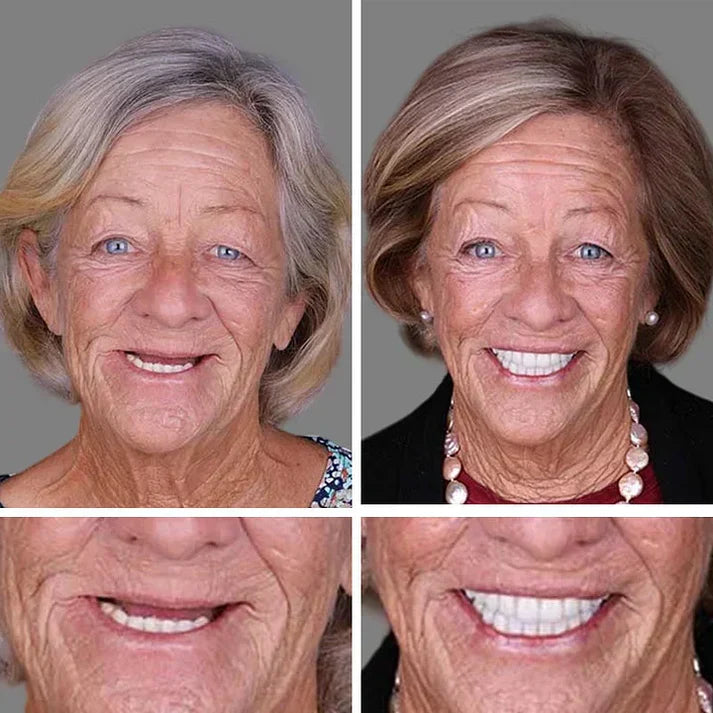 Ends Today: 70% OFF! ⏰ KLENIMORE™ Custom-Fit Smile Support Set — Strong Hold & Natural Look 🦷