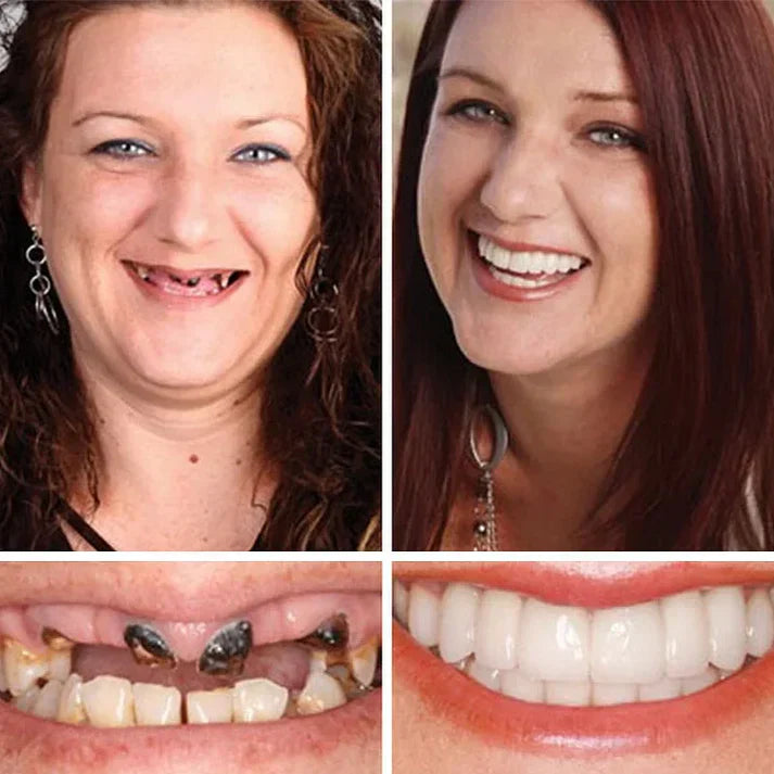 Ends Today: 70% OFF! ⏰ KLENIMORE™ Custom-Fit Smile Support Set — Strong Hold & Natural Look 🦷
