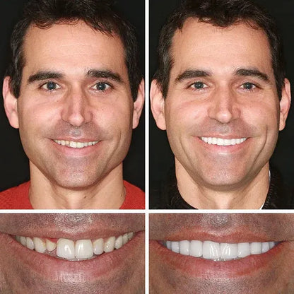 🌎Ends Today: 80% OFF!⏰KLENIMORE™ Custom-Fit Smile Support Kit — Strong Suction Feel & Natural-Looking Fit
