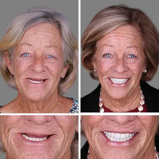 🌎Ends Today: 80% OFF!⏰KLENIMORE™ Custom-Fit Smile Support Kit — Strong Suction Feel & Natural-Looking Fit
