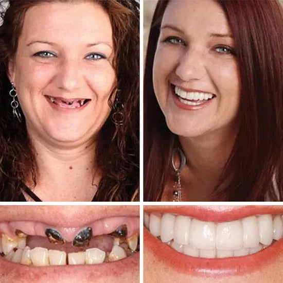 🌎Ends Today: 80% OFF!⏰KLENIMORE™ Custom-Fit Smile Support Kit — Strong Suction Feel & Natural-Looking Fit